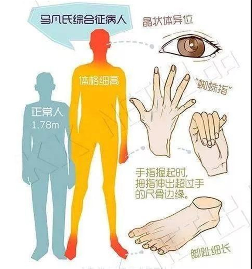 mingci hospital|你听说过"马凡综合征"吗?无锡19岁大学生因它险丢命